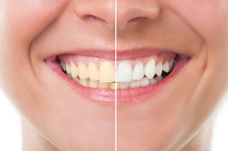 Teeth Whitening in Wilmington